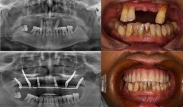 佛山种牙爆料事件最新,揭露行业乱象，患者权益如何保障？